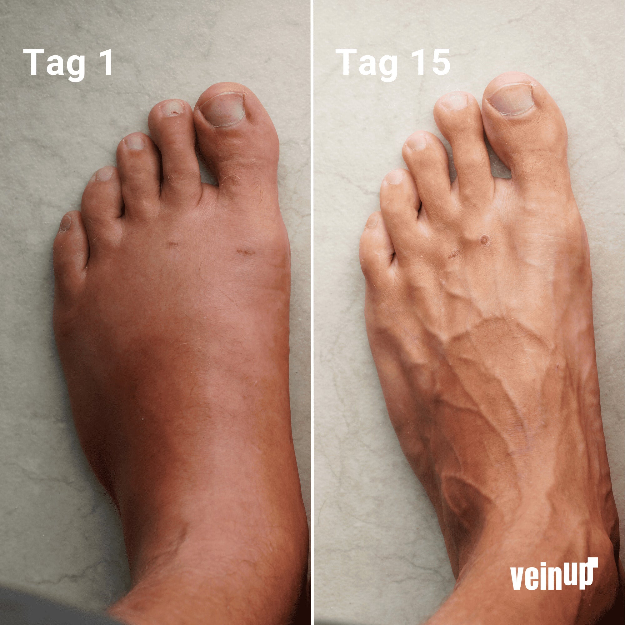 5 Paar Kompressionsstrümpfe im Vorteilspack - VeinUp